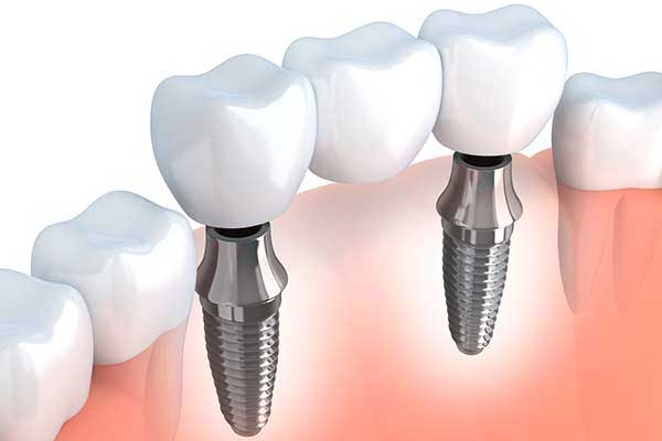 Hoboken Dental Implant Services